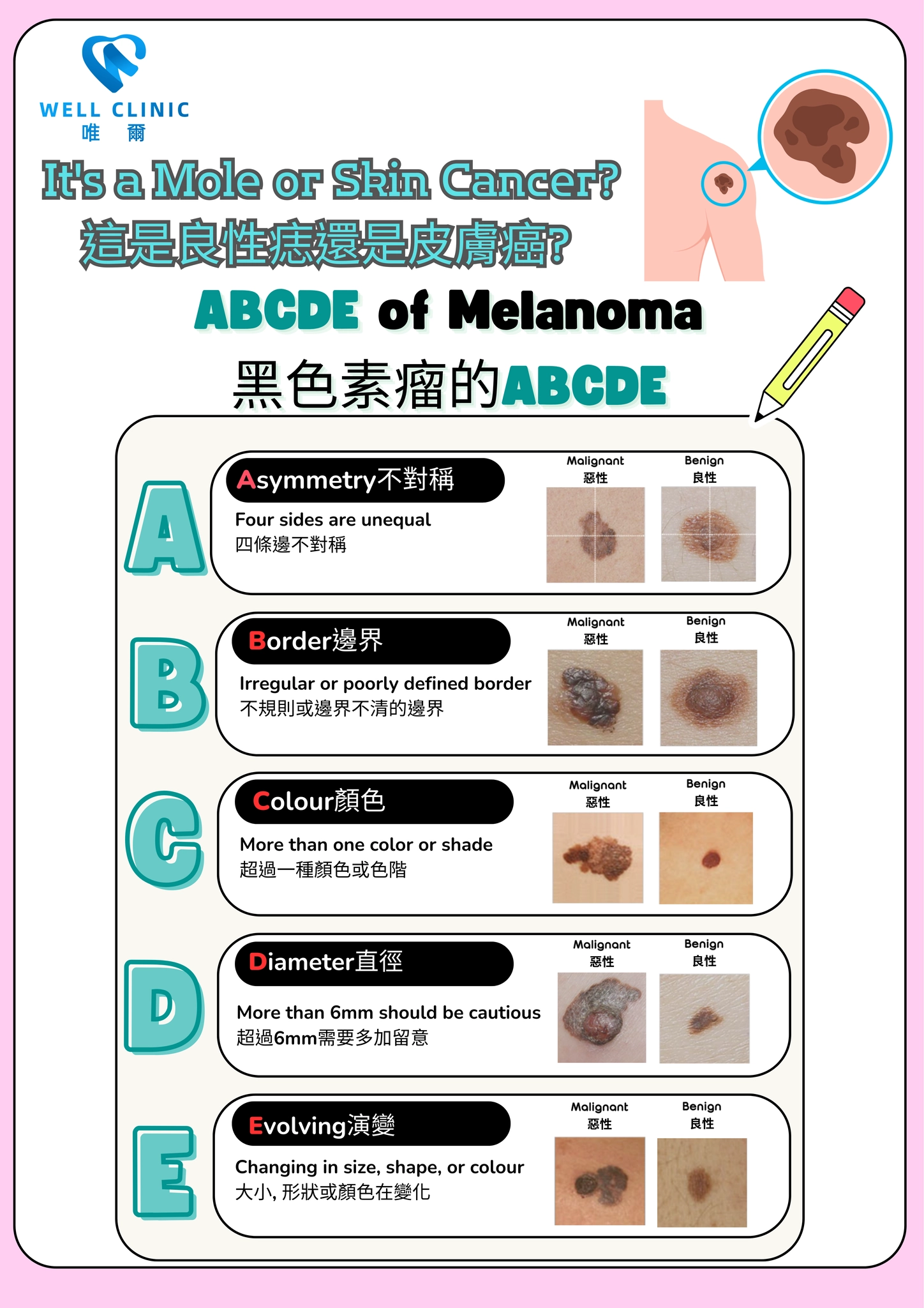這是良性痣還是皮膚癌？